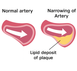 plaque build up in artery simple diagram