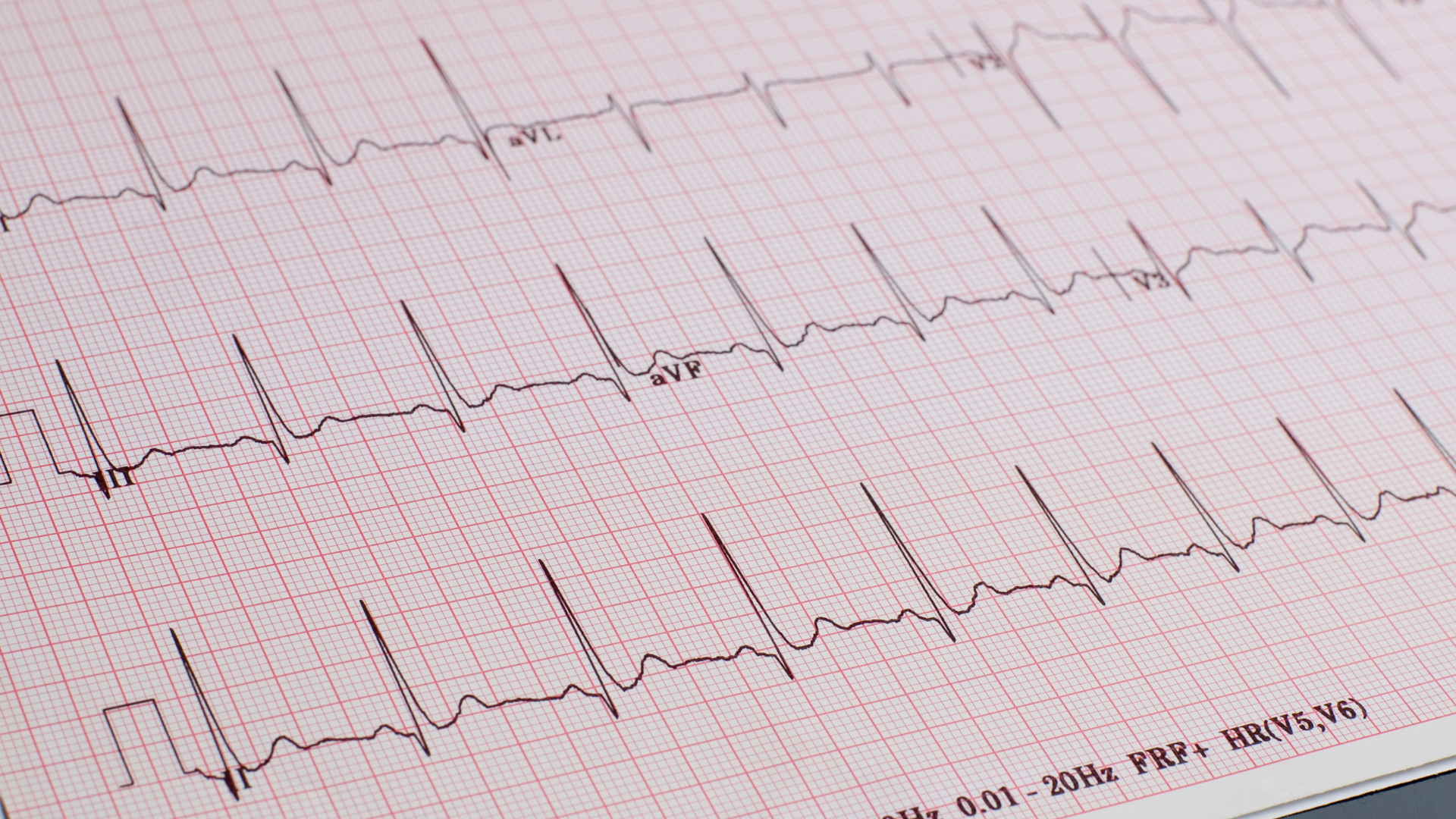 Arrhythmias stock image
