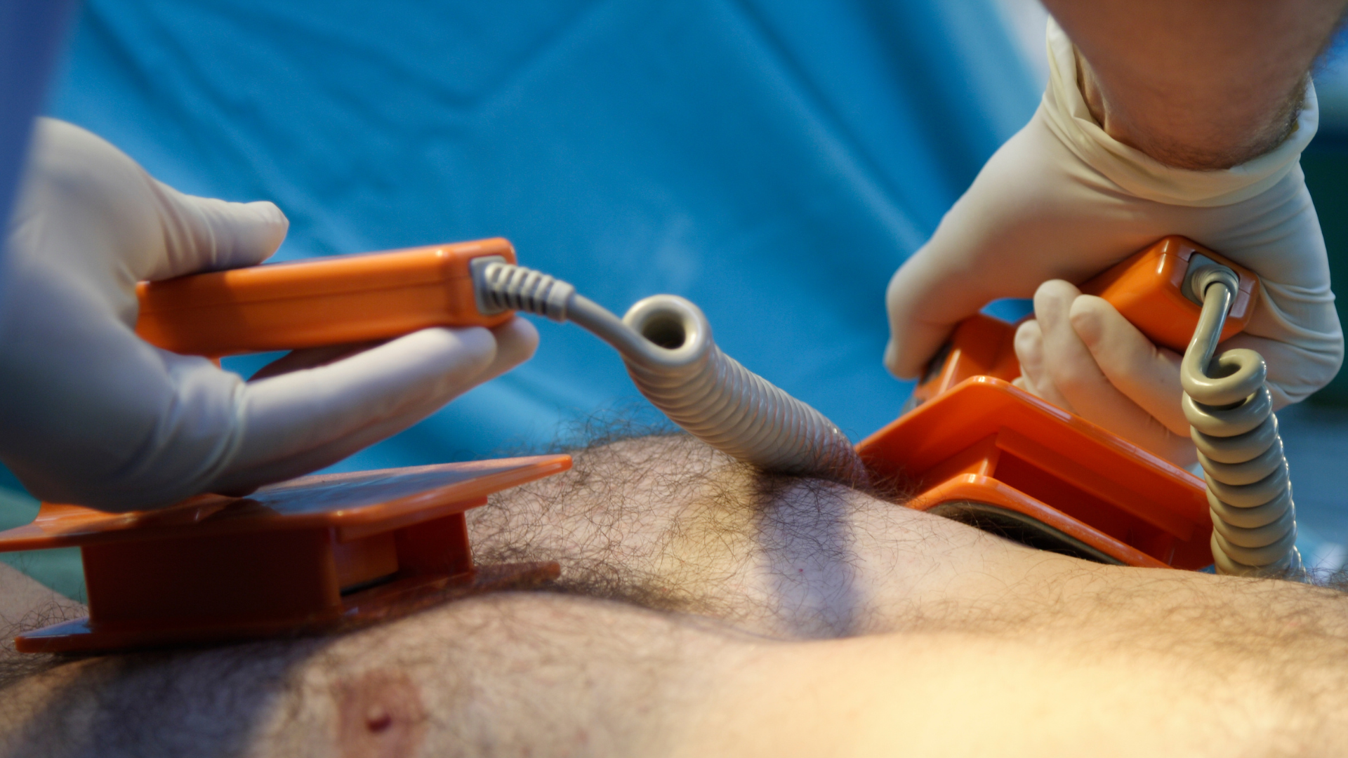 Cardioversion stock image