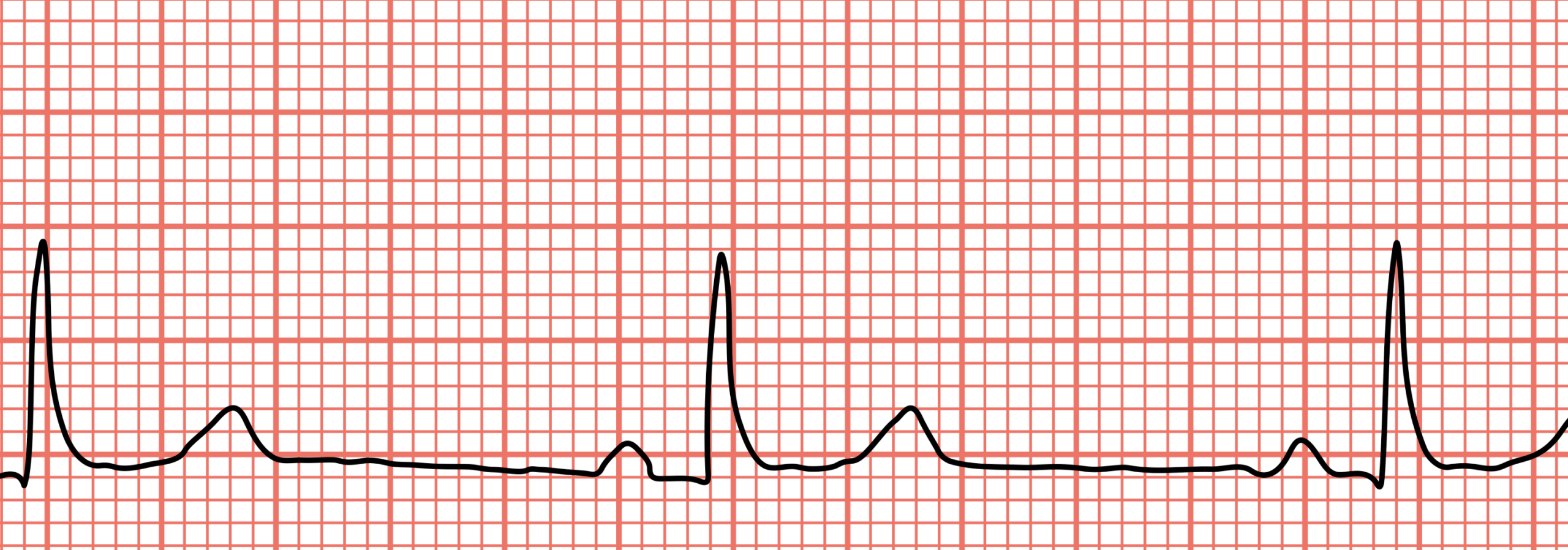 bradycardia